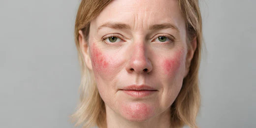 What is Rosacea and how can LED light therapy help?