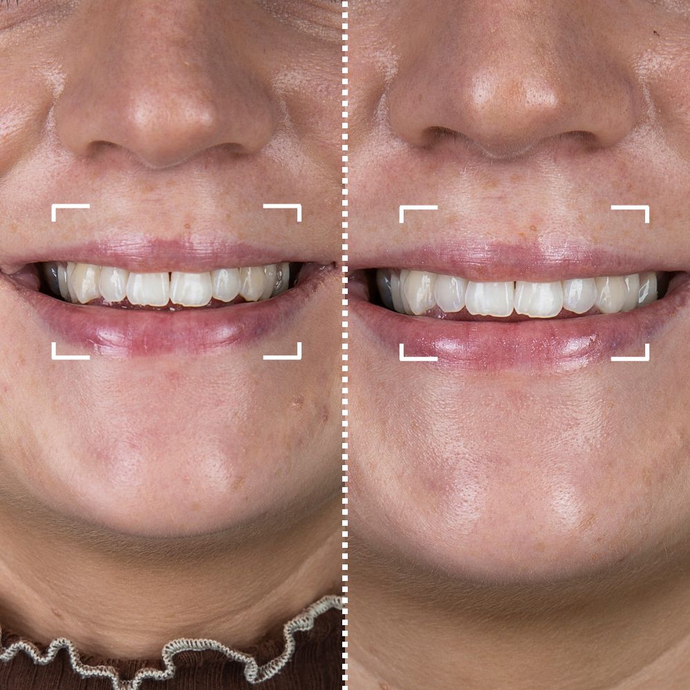 Before & After