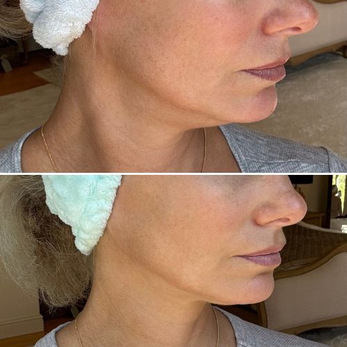 Before & After