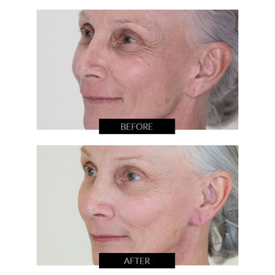 NIRA Pro Laser - CurrentBody Exclusive