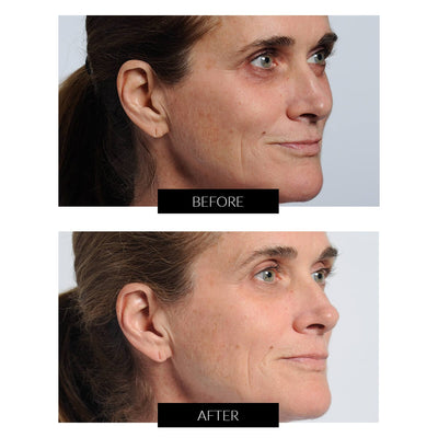 NIRA Pro Laser - CurrentBody Exclusive