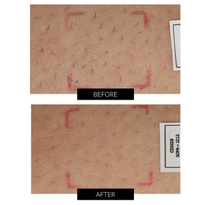 SmoothSkin Pure Fit IPL Hair Removal Device