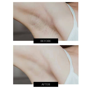 JOVS Venus Pro Skin Rejuvenation and IPL Hair Removal Device