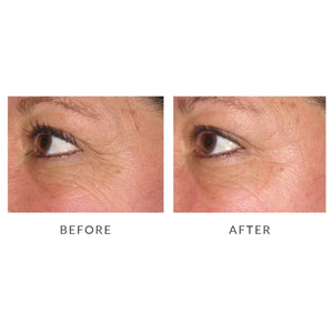 Before and After Eye reviews after using the Silk'n FaceTite