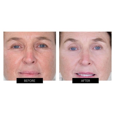 NIRA Precision Skincare Laser