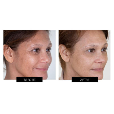 NIRA Precision Skincare Laser