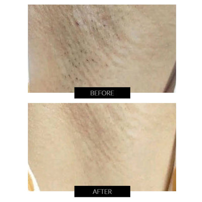 Ulike Rose IPL Hair Removal & Anti-Ageing Device