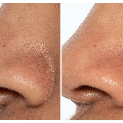 BeautyBio GLOfacial Hydro-Infusion Pore Cleansing Tool