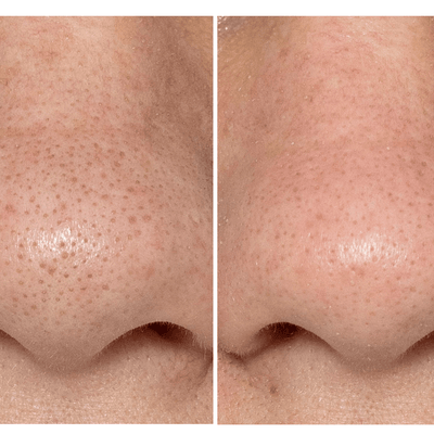 BeautyBio GLOfacial Hydro-Infusion Pore Cleansing Tool