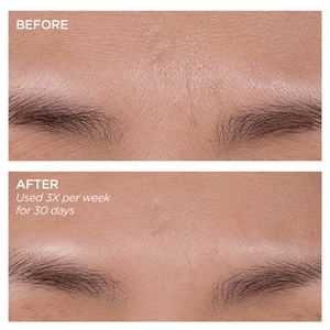 GloPRO Microneedling Regeneration Tool